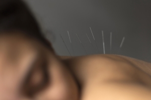 Close-up of acupuncture treatment
